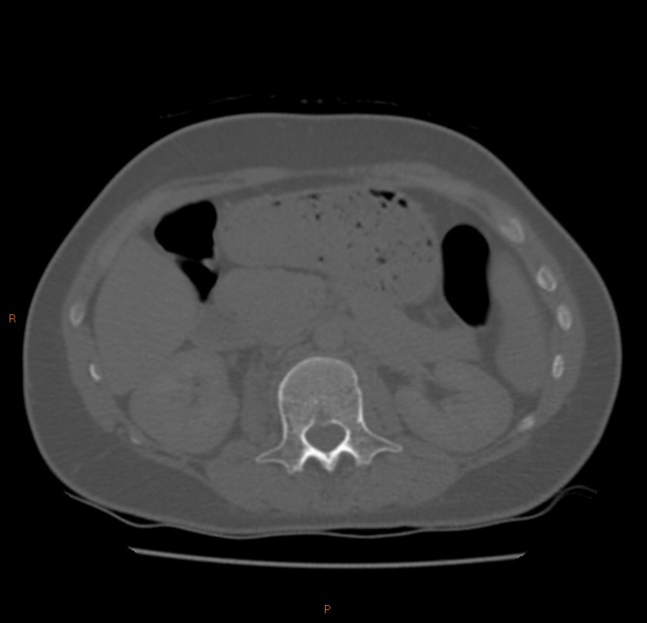 File:Tuberculosis - pleural, pulmonary, discitis (Radiopaedia 92606 ...