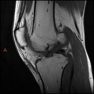 Osteopoikilosis | Image | Radiopaedia.org