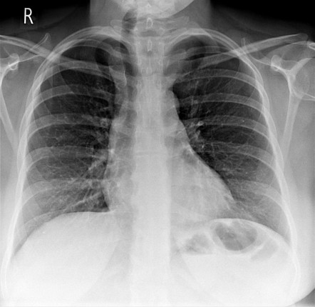 Papillary thyroid cancer | Radiology Case | Radiopaedia.org