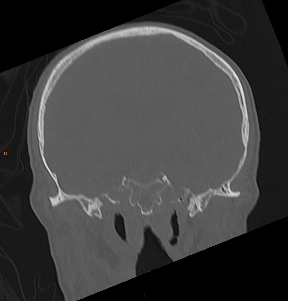 Bilateral Temporomandibular Joint Dislocation | Image | Radiopaedia.org