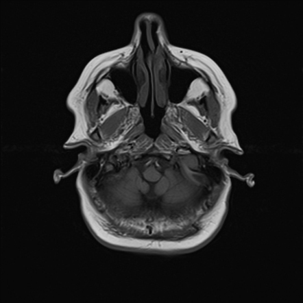 Sluggish cerebral venous flow | Image | Radiopaedia.org