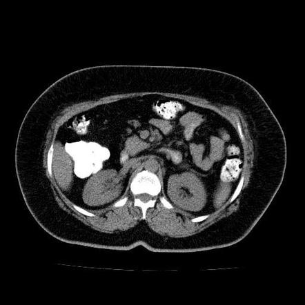 Hodgkin Lymphoma Mesenteric And Retroperitoneal Lymphadenopathy Radiology Case Radiopaedia Org