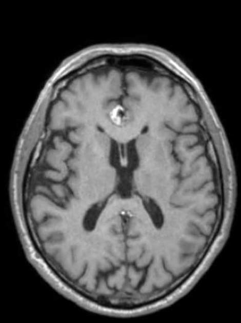 Azygos anterior cerebral artery | Radiology Reference Article ...