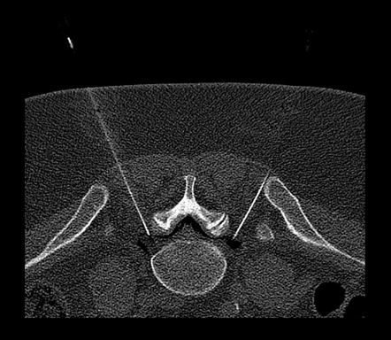 Bilateral L5 transforaminal epidural steroid injections (CT guided ...