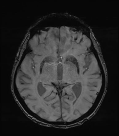 Alzheimer disease or LATE | Image | Radiopaedia.org