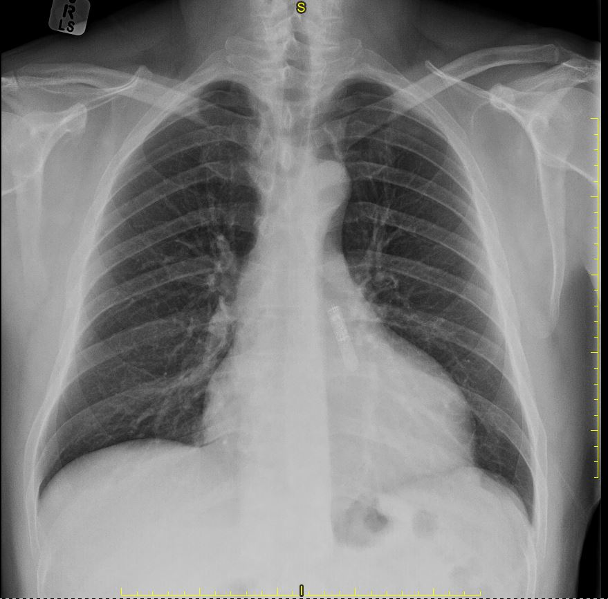 Confirm Rx® insertable cardiac monitor (ICM) | Image | Radiopaedia.org