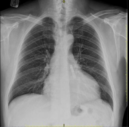 Confirm Rx® Insertable Cardiac Monitor (icm) 