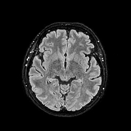 Lateral medullary syndrome | Image | Radiopaedia.org