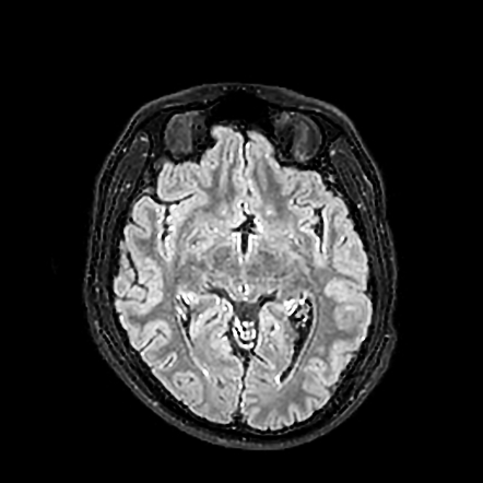 Maxillary sinus atelectasis | Image | Radiopaedia.org