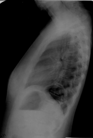 Pediatric Hiatal Hernia | Image | Radiopaedia.org