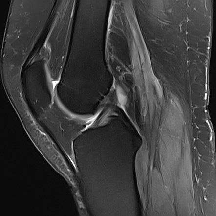 Medial gastrocnemius tendinopathy | Radiology Case | Radiopaedia.org