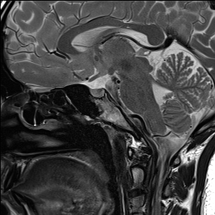 Pineocytoma | Radiology Case | Radiopaedia.org