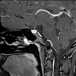 Pineocytoma | Image | Radiopaedia.org