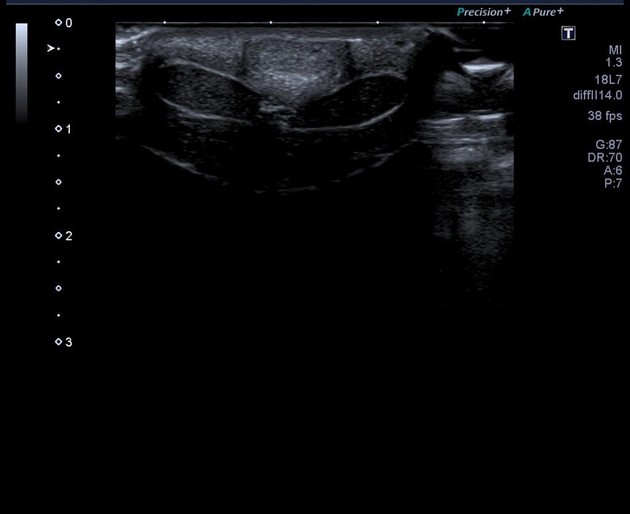 Erectile dysfunction secondary to venous incompetence Radiology