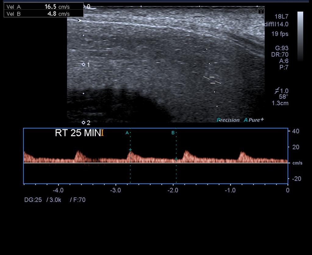 Erectile dysfunction secondary to venous incompetence Image