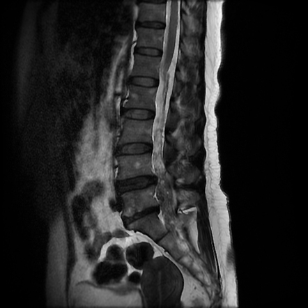 Spinal neurocysticercosis | Radiology Case | Radiopaedia.org