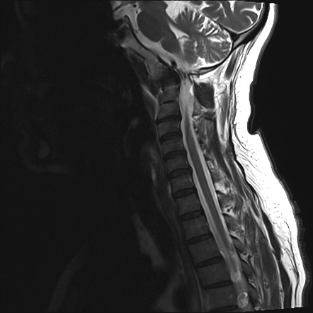 Atlantooccipital assimilation with basilar invagination | Radiology ...