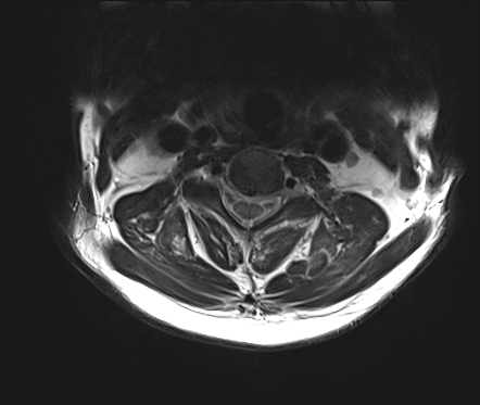 Atlantooccipital assimilation with basilar invagination | Image ...