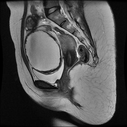 Adnexal torsion | Image | Radiopaedia.org