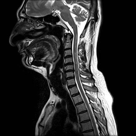 Subacute combined degeneration of the cord | Radiology Case ...