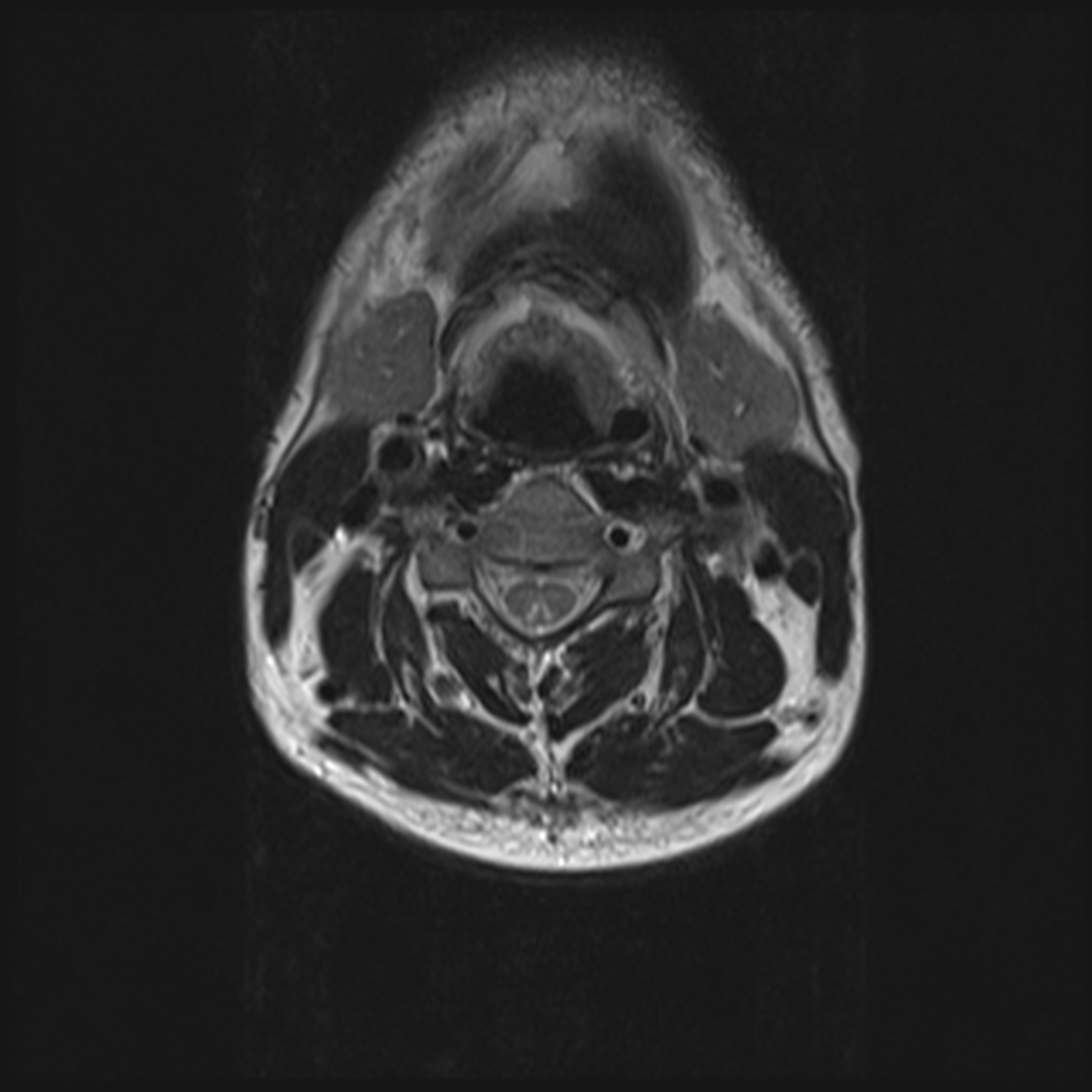 Subacute combined degeneration of the cord | Image | Radiopaedia.org