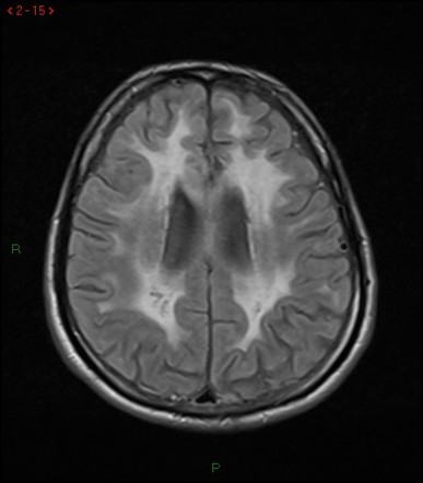 Cerebral autosomal dominant arteriopathy with subcortical infarcts and ...