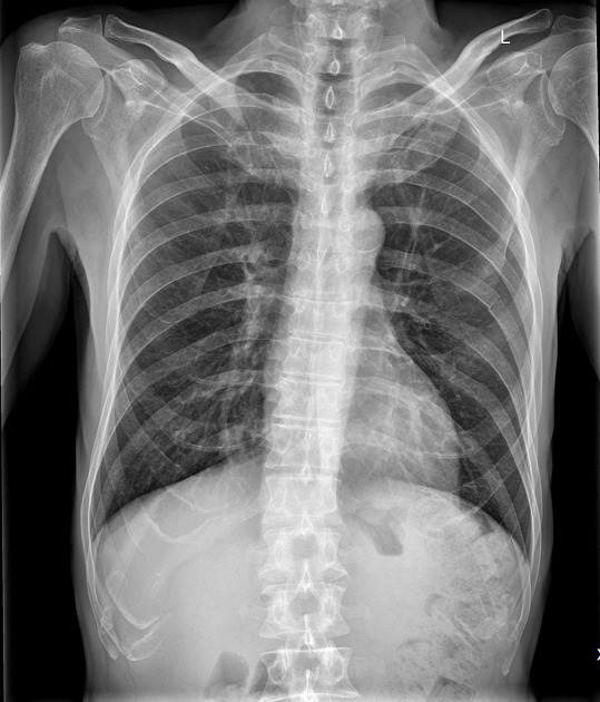 Rib fracture Radiology Case Radiopaedia