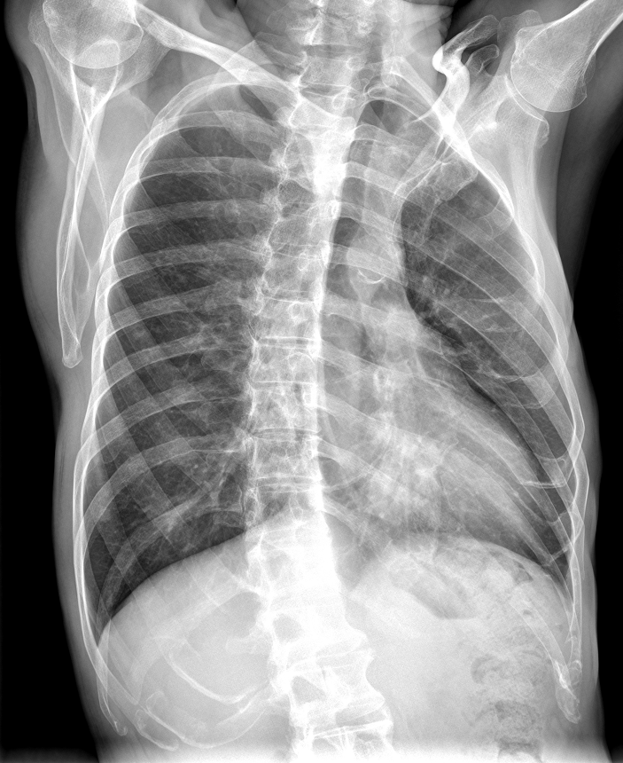 Rib Fractures After Percutaneous Radiofrequency And My Xxx Hot Girl