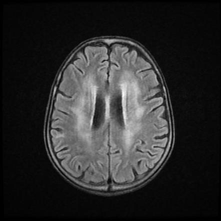 Radiation-induced leukoencephalopathy | Radiology Case | Radiopaedia.org