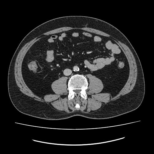 Cecal diverticulitis | Image | Radiopaedia.org