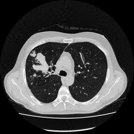 Allergic Bronchopulmonary Aspergillosis | Radiology Case | Radiopaedia.org