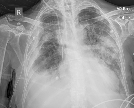 Sclerotic bone metastases | Radiology Reference Article | Radiopaedia.org