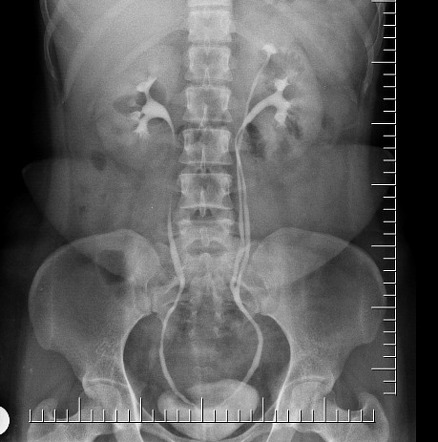 Incomplete double ureter | Radiology Case | Radiopaedia.org