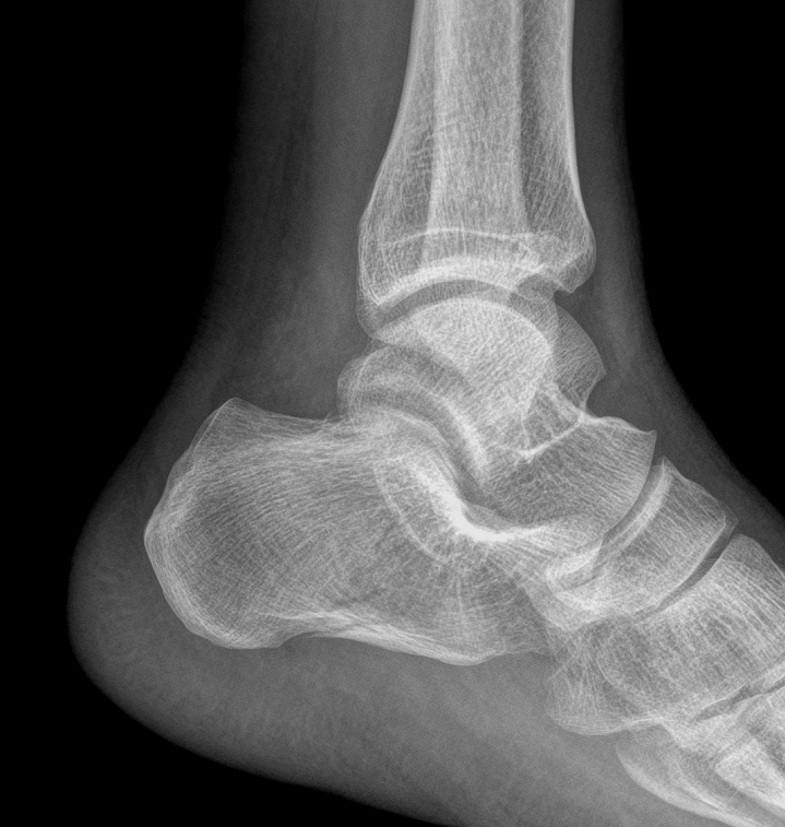 Lateral Ankle X Ray Anatomy