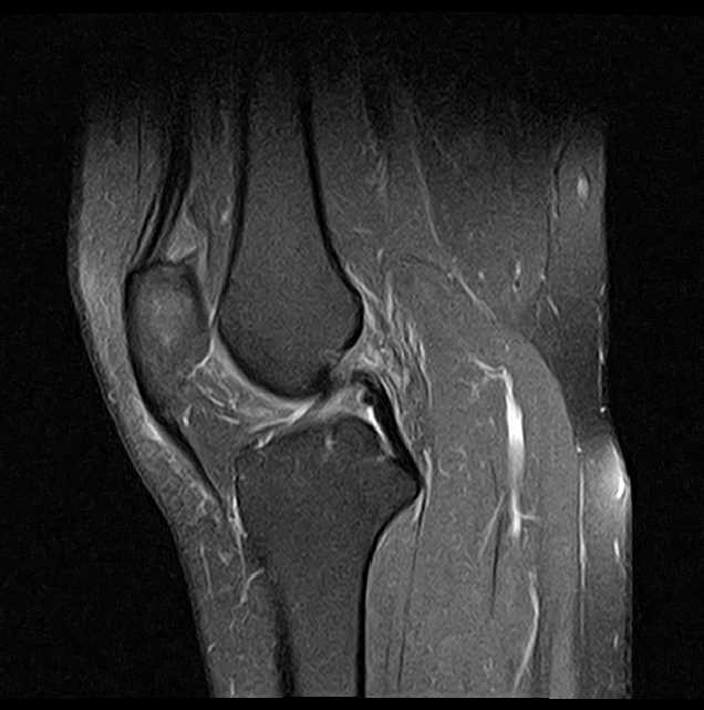 Hoffa fat pad herniation | Image | Radiopaedia.org