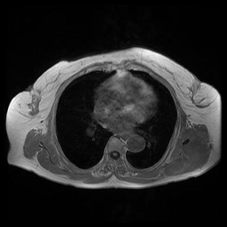 Diffuse Large B Cell Lymphoma - Soft Tissues | Image | Radiopaedia.org