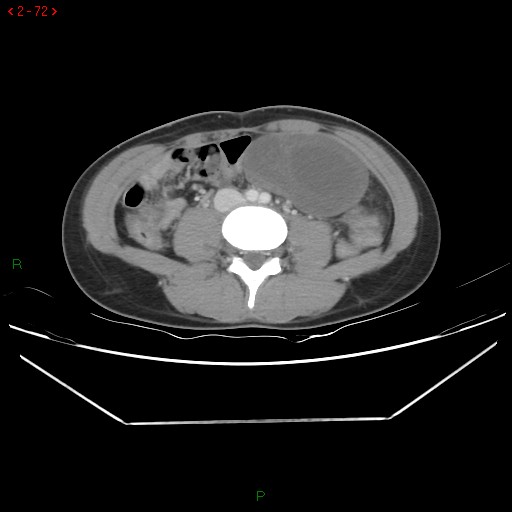 Ovarian Torsion Image