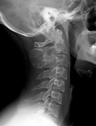 Aneurysmal bone cyst - cervical spine | Image | Radiopaedia.org