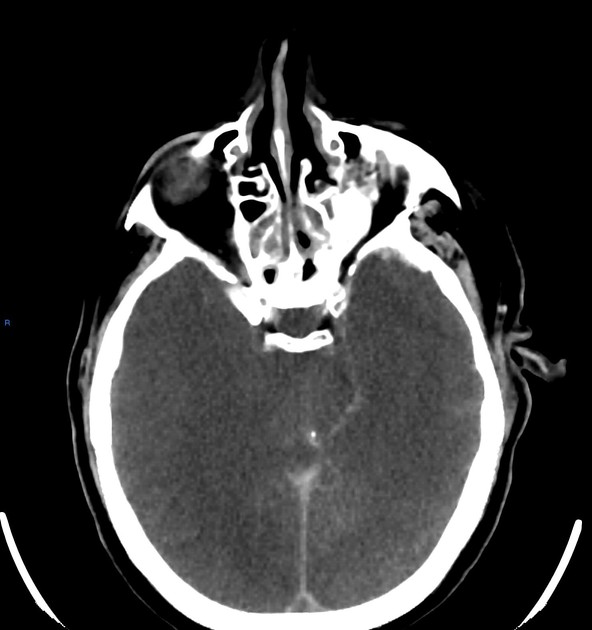 Hypoxic and anoxic brain injury