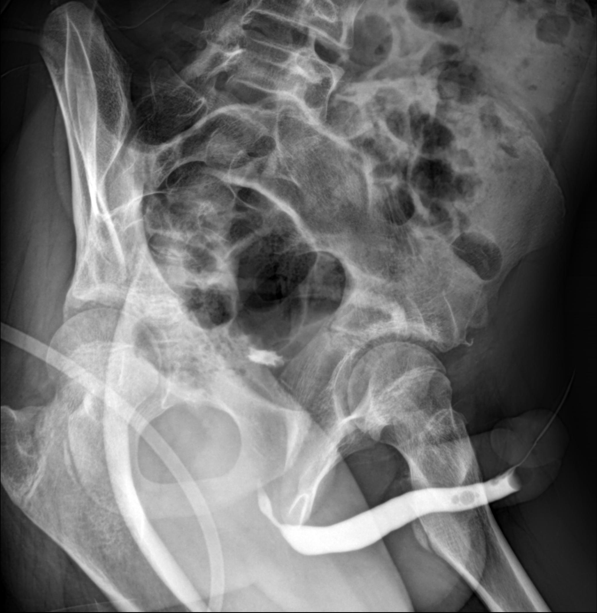 Urethral Stricture Image