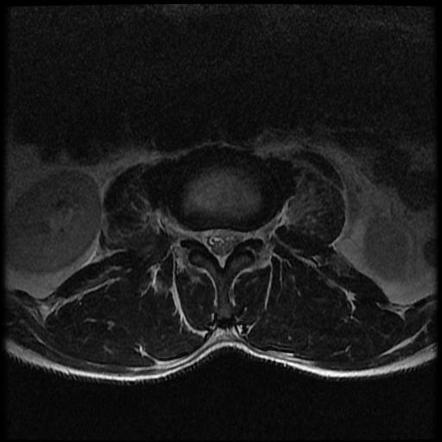 icd 10 l3 compression fracture