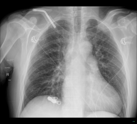 Clavicular fracture | Radiology Reference Article | Radiopaedia.org