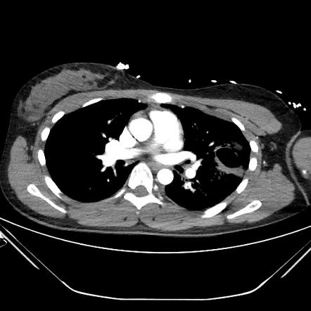 Pulmonary lacerations | Image | Radiopaedia.org