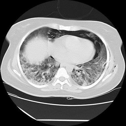 COVID-19 pneumonia with spontaneous pneumomediastinum | Radiology Case ...