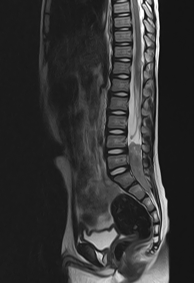 Ependymoma Drop Metastases Image Radiopaedia Org