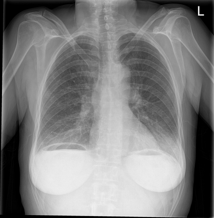 Pneumoperitoneum | Radiology Case | Radiopaedia.org