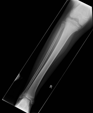 Osteoid osteoma | Radiology Case | Radiopaedia.org