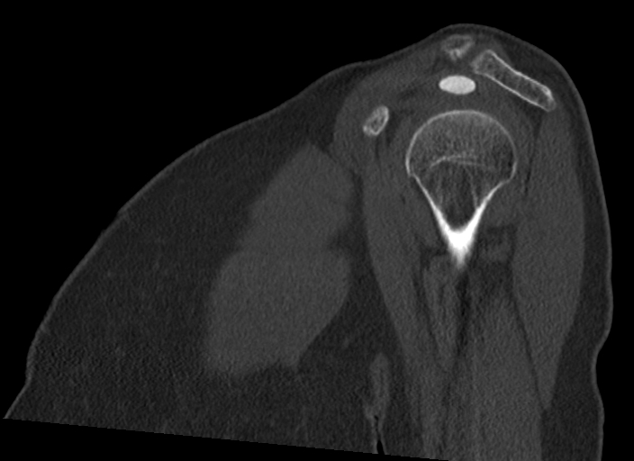 Calcific Tendinitis Of The Supraspinatus Tendon Image Radiopaedia Org