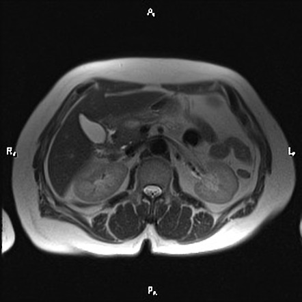 Pancreatic Neuroendocrine Tumor | Image | Radiopaedia.org