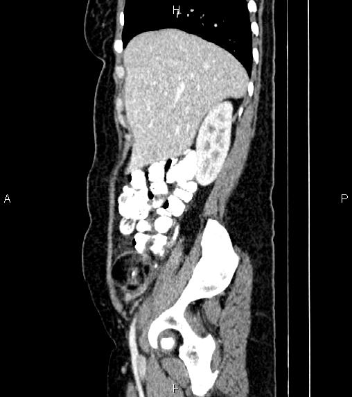 Ovarian dermoid cyst | Image | Radiopaedia.org